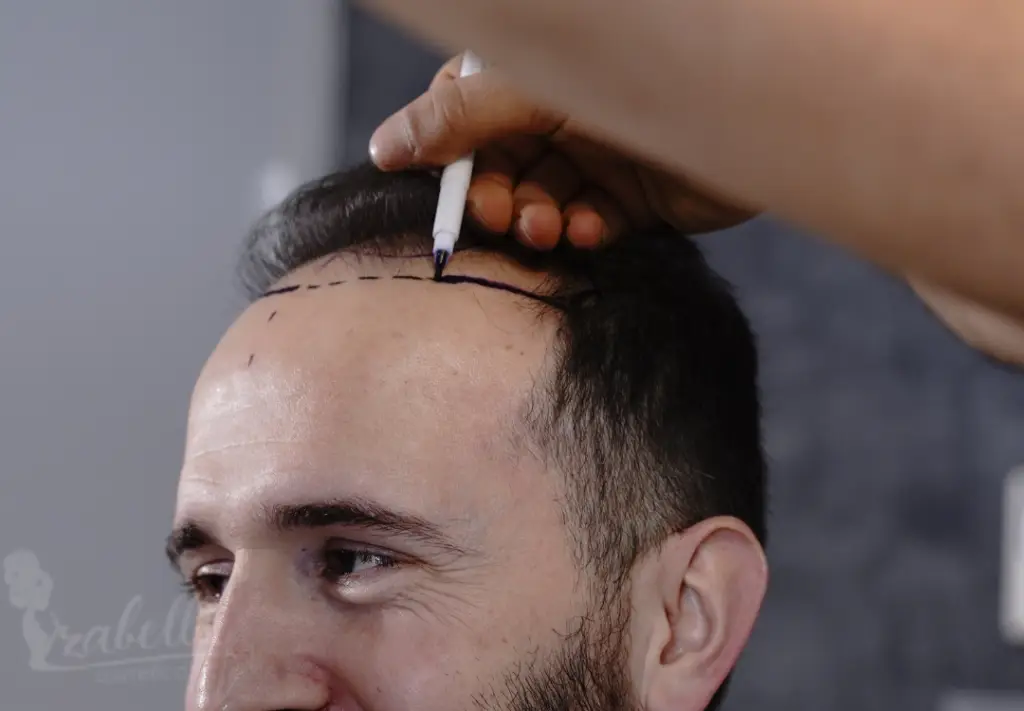 اسعار زراعة الشعر بتقنية dhi