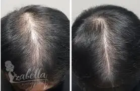 زراعة الشعر بالريجينيرا