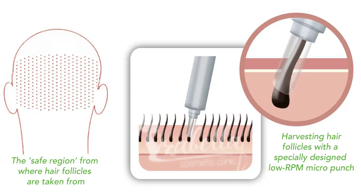 تقنية السفير لزراعة الشعر