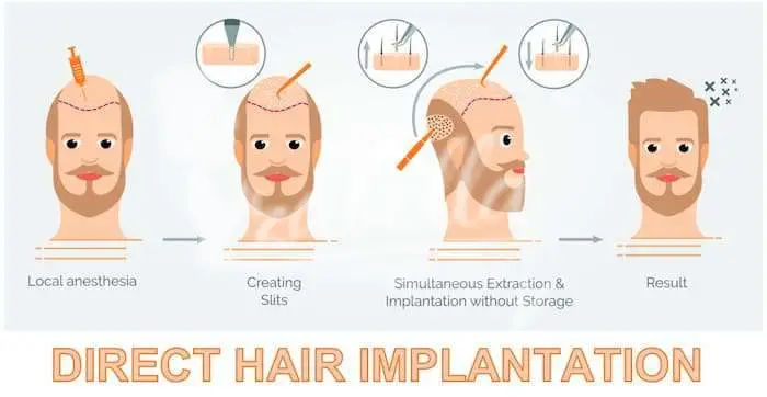 تقنيات زراعة الشعر في مصر