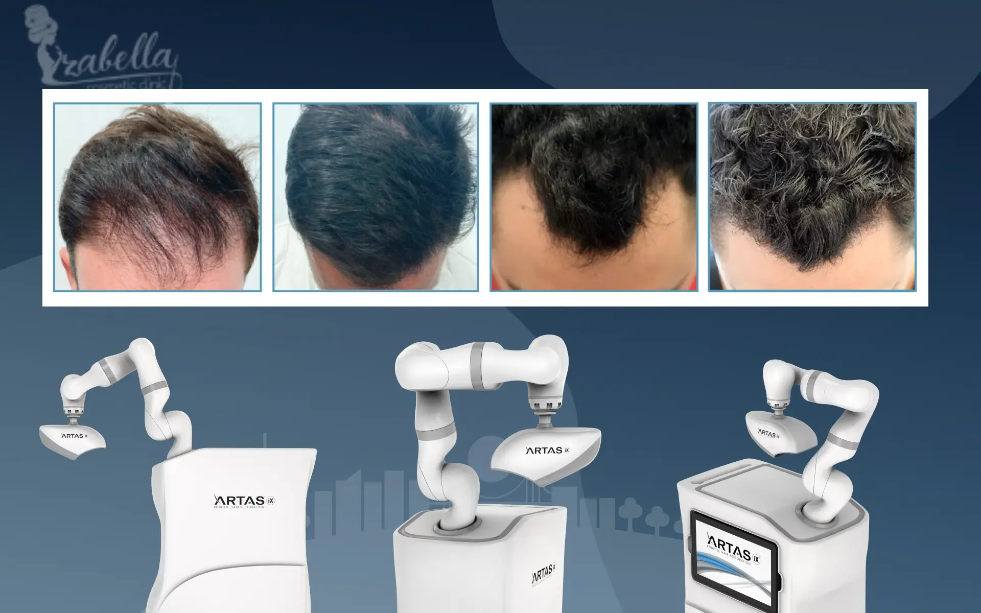 زراعة الشعر بتقنية الروبوت ارتاس