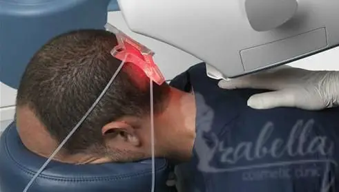تقنيات زراعة الشعر 2024