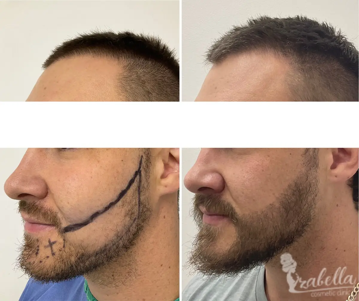 زراعة شعر الذقن في مصر