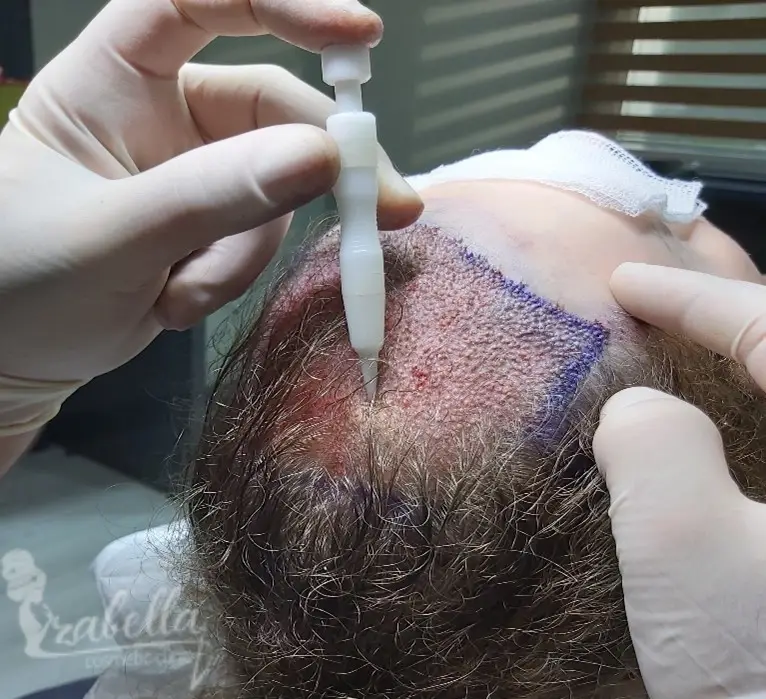 زراعة الشعر بقلم تشوي