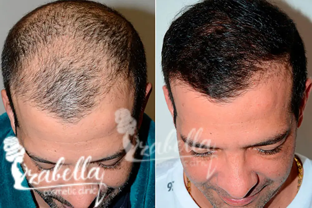 زراعة الشعر بتقنية الاقتطاف