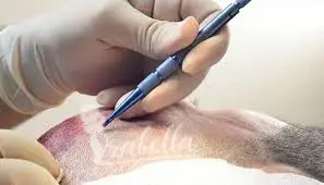 زراعة الشعر بتقنية السفير