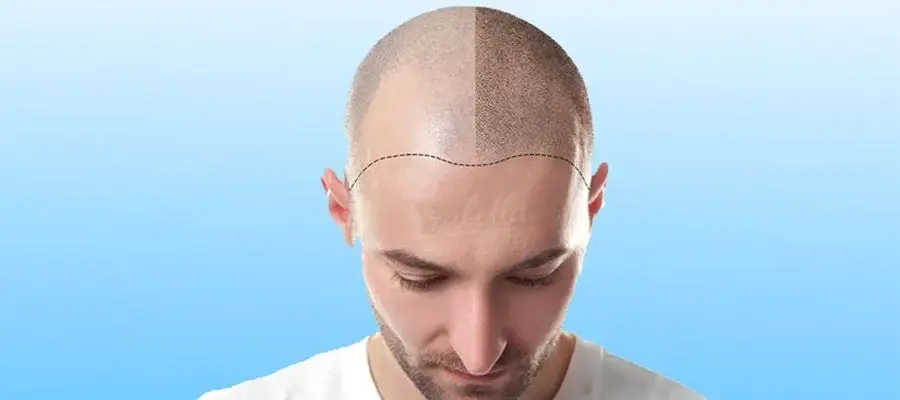 زراعة الشعر بتقنية dhi