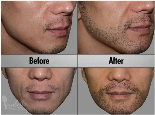 سعر زراعة شعر الذقن في مصر