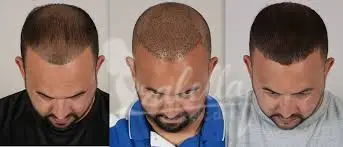 عدد جلسات زراعة الشعر بتقنية الاقتطاف