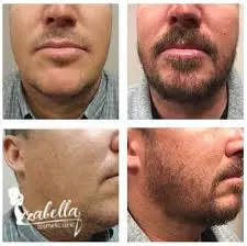 عملية زراعة شعر الذقن
