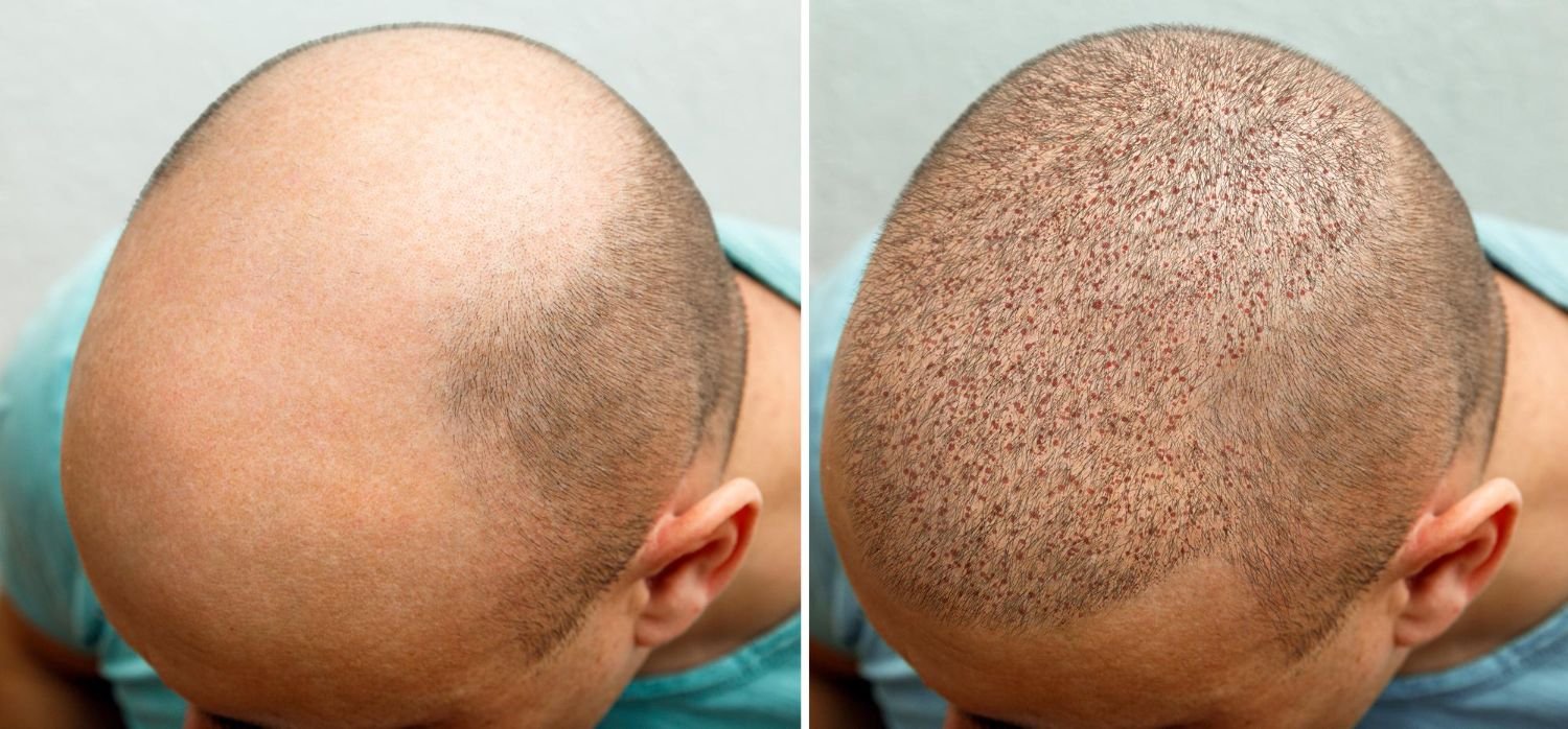 عيادات زراعة الشعر للرجال