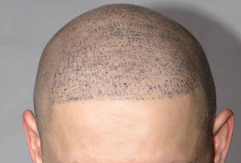 بديل زراعة الشعر smp