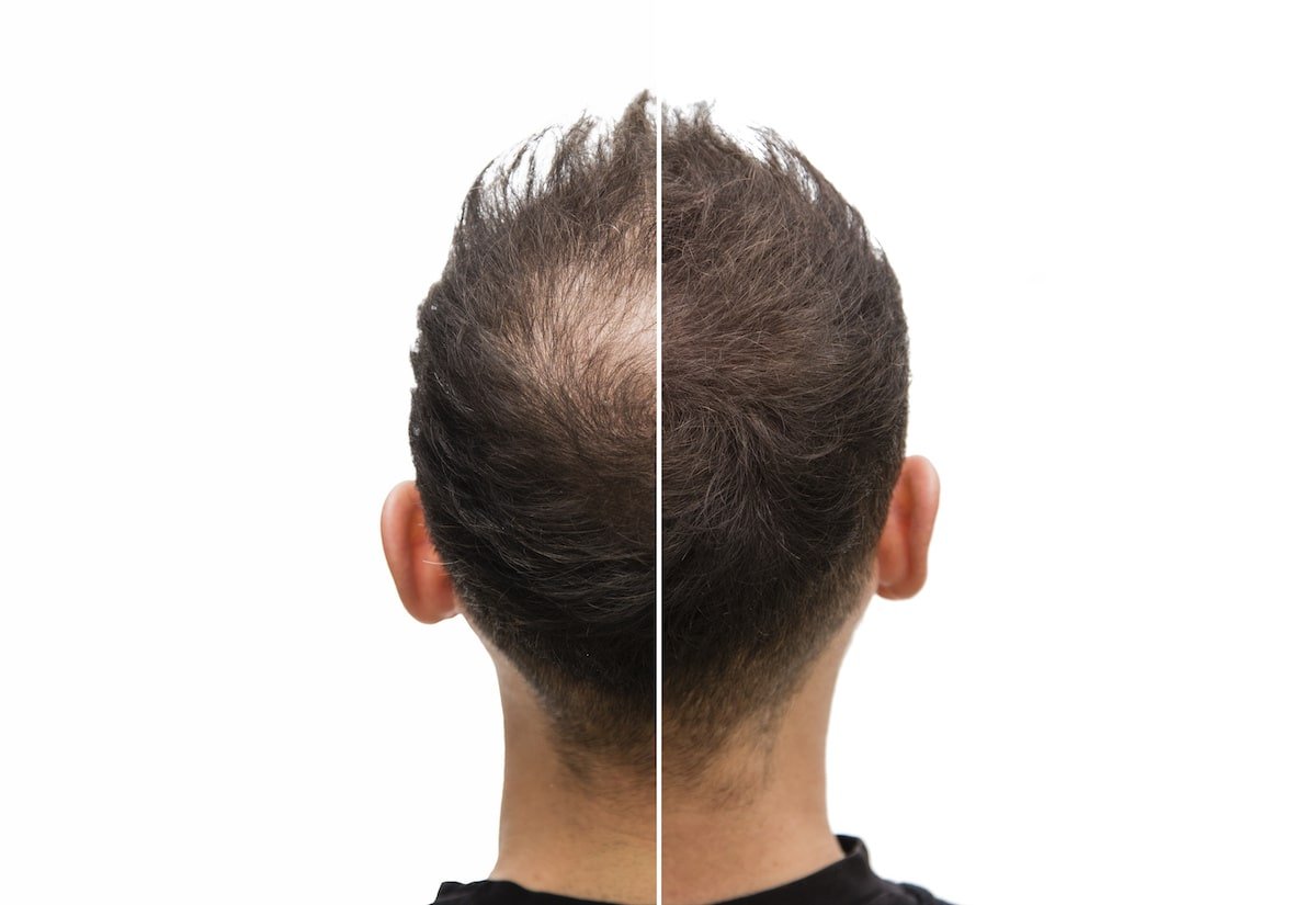 مميزات بديل زراعة الشعر smp