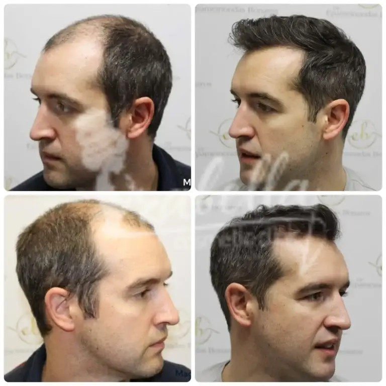 تكلفة زراعة الشعر بالجنيه المصري
