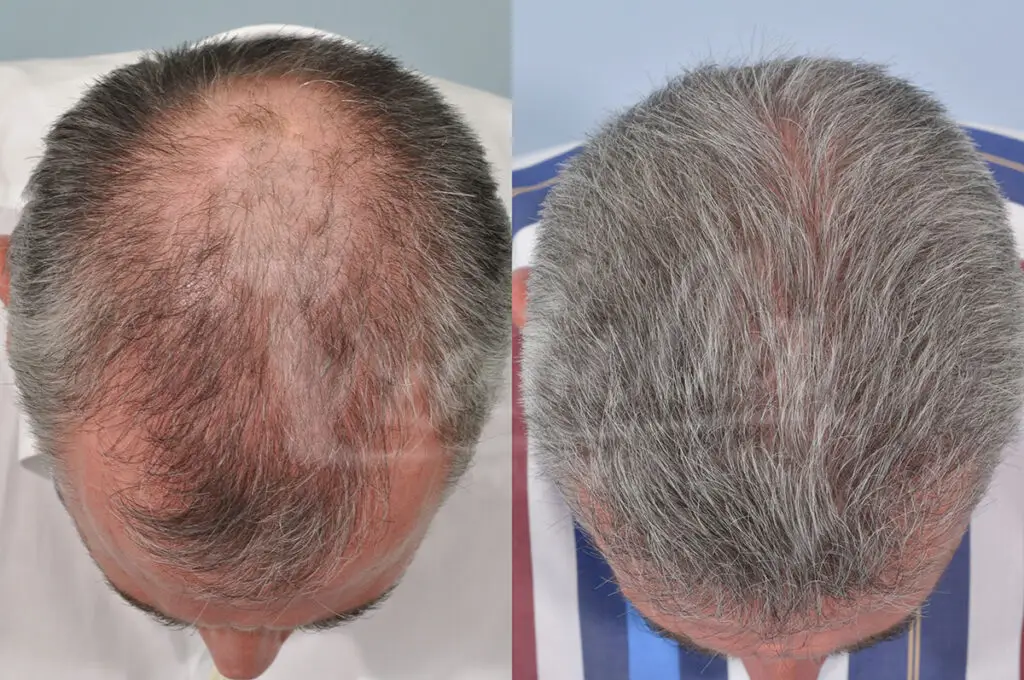 زراعة الشعر في مصر