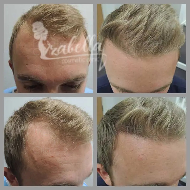 عمليات زراعة الشعر