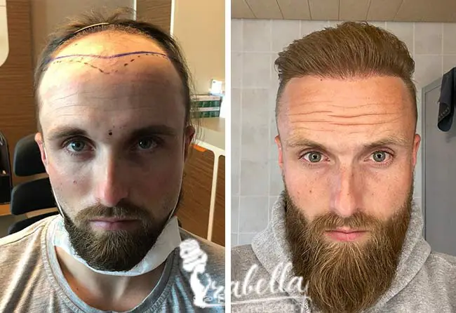 عملية زراعة الشعر