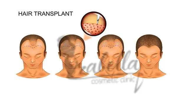 ما هي عملية زراعة الشعر