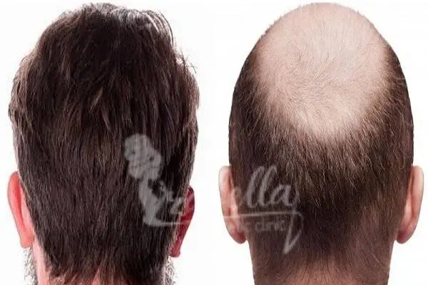 نسبة نجاح عملية زراعة الشعر