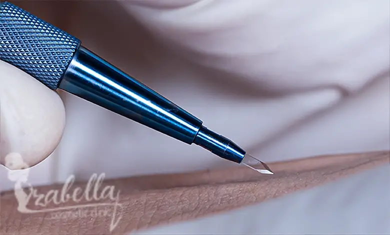 تقنية السفير لزراعة الشعر