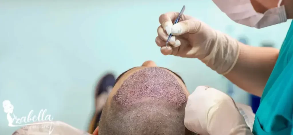 تقنية سفير لزراعة الشعر 2024
