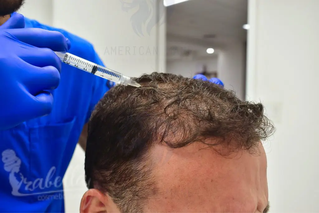علاج تساقط الشعر بالميزوثيرابي