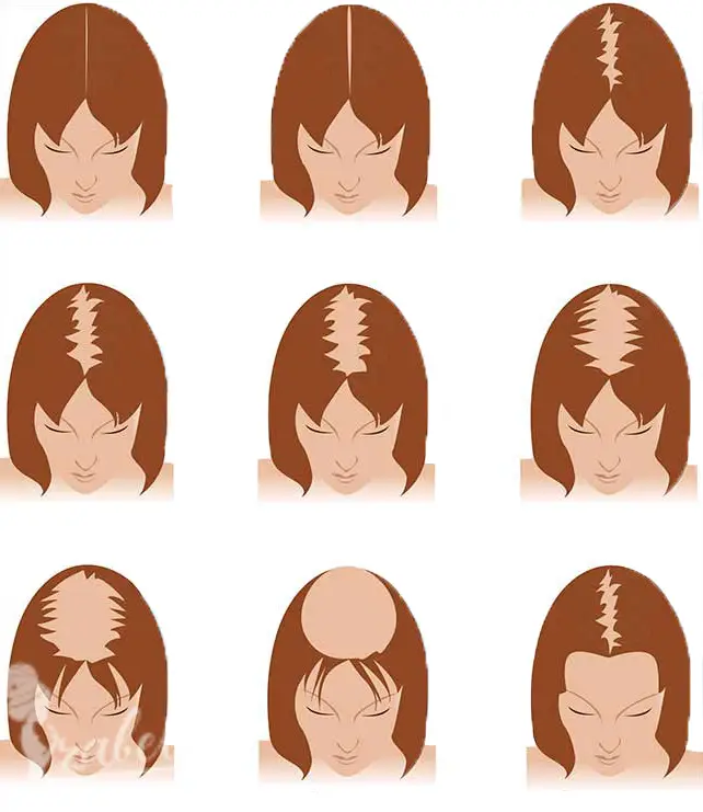أشكال الصلع الوراثي عند النساء