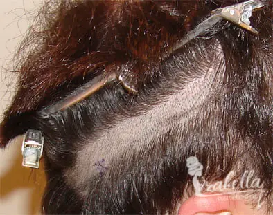 تقنية الشريحة fut لزراعة الشعر