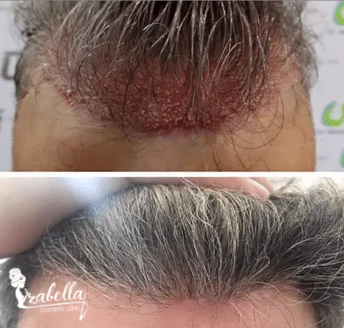 تكلفة زراعة الشعر بدون حلاقة في مصر