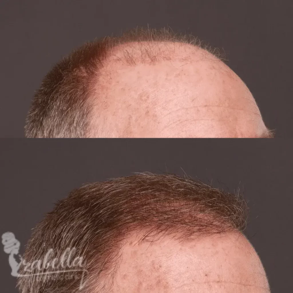زراعة الشعر بتقنية FUE