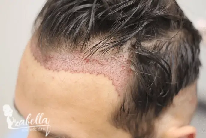 مين جرب زراعة الشعر في مصر؟