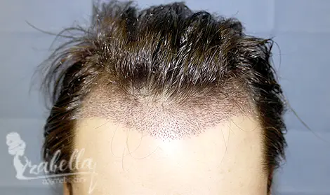 زراعة خط الشعر الامامي