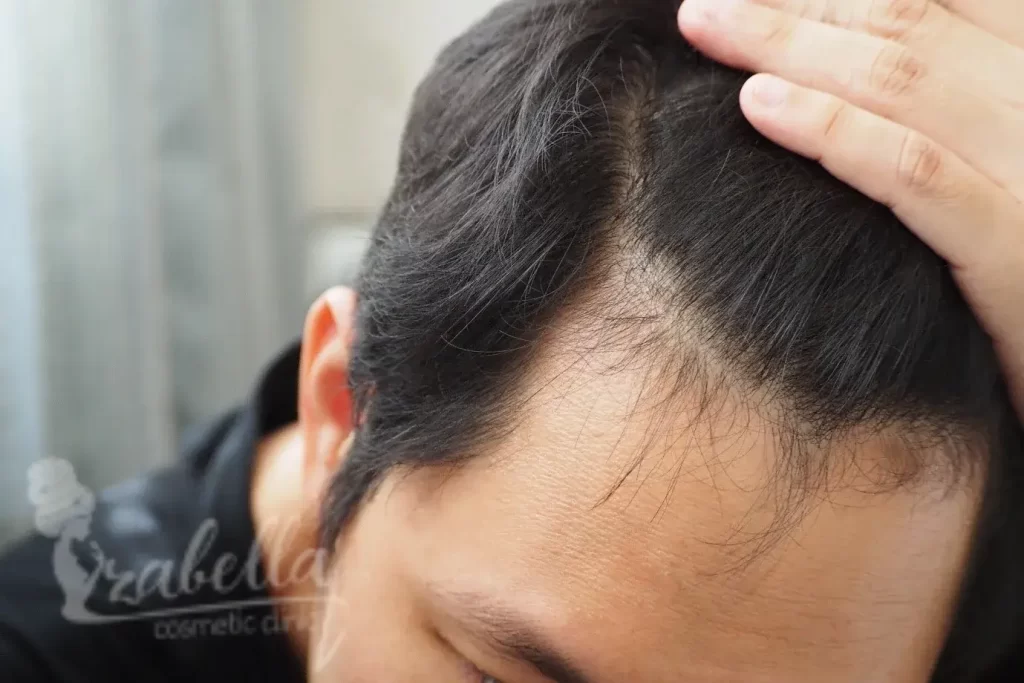 علاج تساقط الشعر عند سحبه