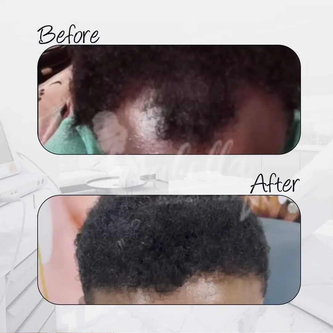 اضرار زراعة الشعر بالاقتطاف