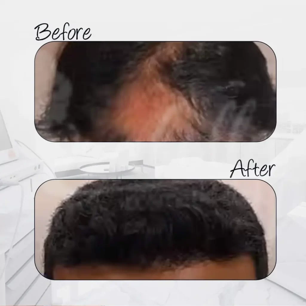 تجربتي مع زراعة الشعر بالاقتطاف