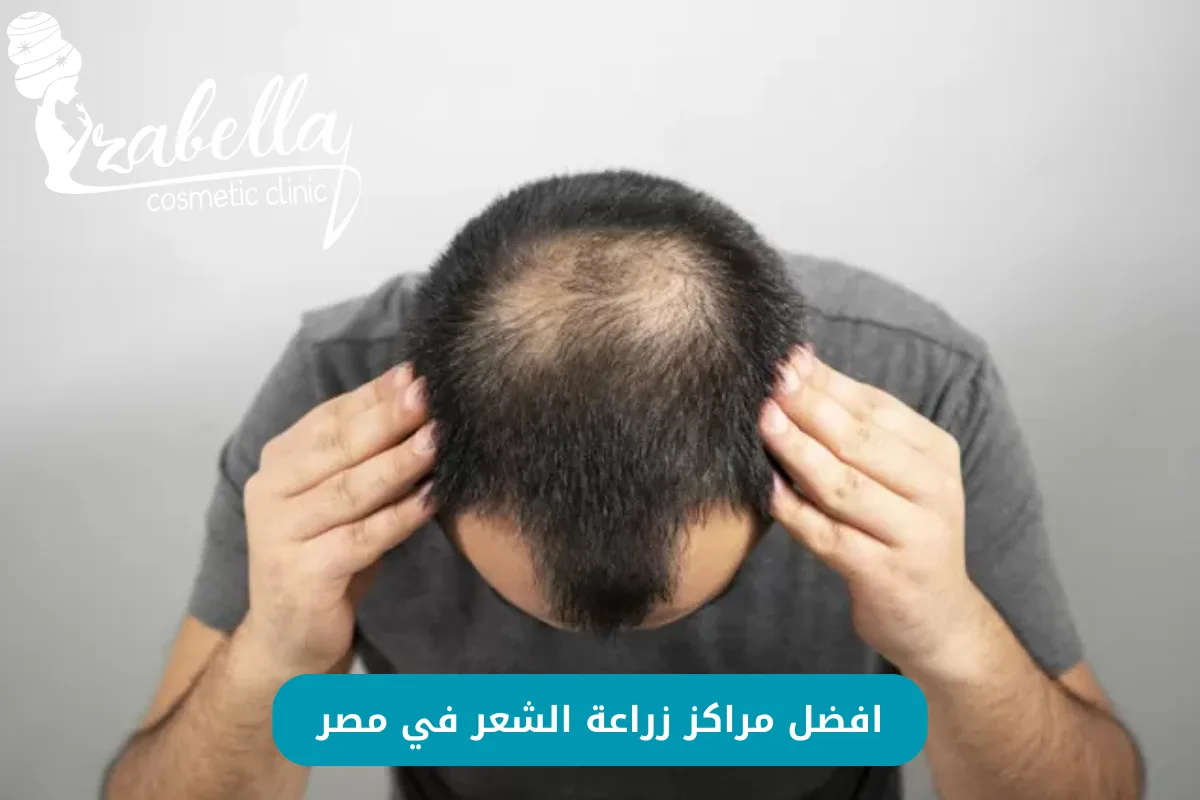 مراكز زراعة الشعر في مصر