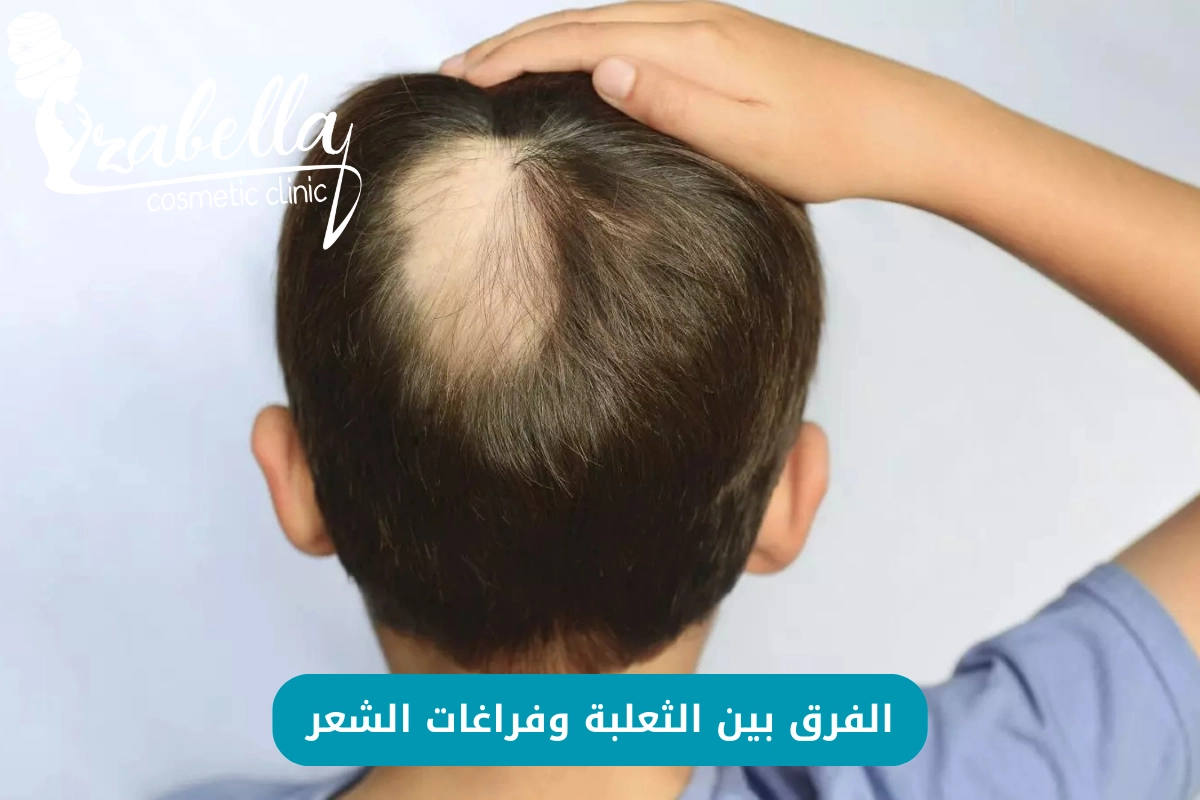 ما هو الفرق بين الثعلبة وفراغات الشعر