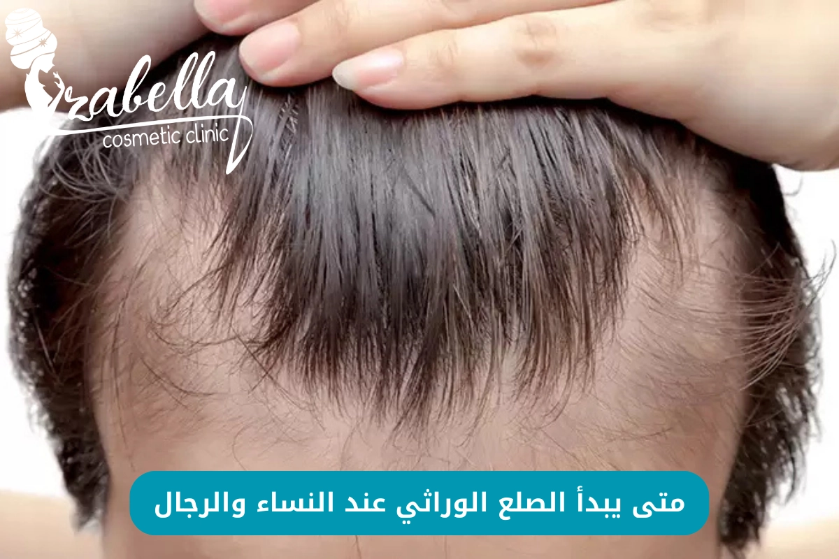 متى يبدأ الصلع الوراثي عند الشباب