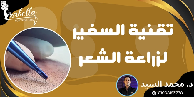تقنية السفير لزراعة الشعر