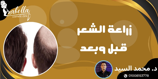 زراعة الشعر قبل وبعد
