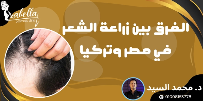 الفرق بين زراعة الشعر في مصر وتركيا