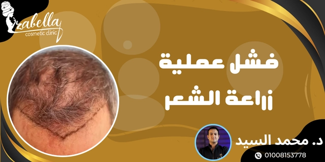 فشل عملية زراعة الشعر