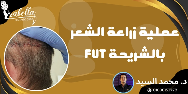 زراعة الشعر بالشريحة fut