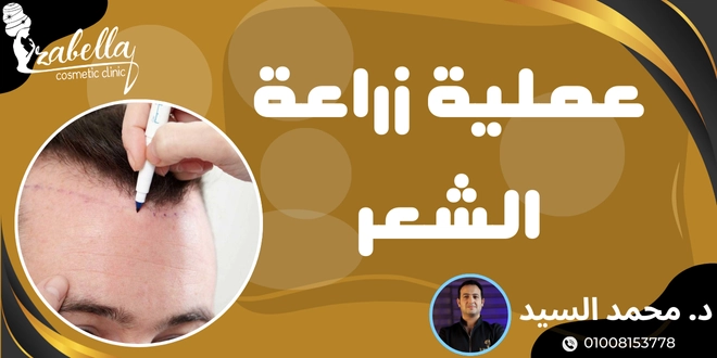 عملية زراعة الشعر
