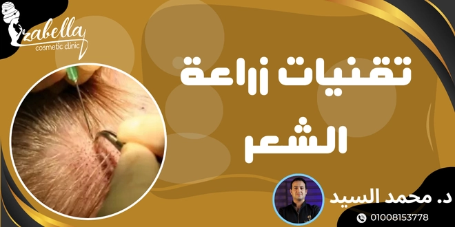 تقنيات زراعة الشعر