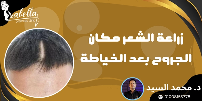 زراعة الشعر مكان الجروح بعد الخياطة
