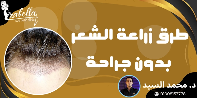 طرق زراعة الشعر بدون جراحة