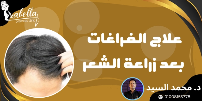 فراغات الشعر بعد الزراعة