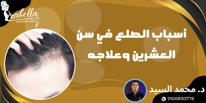 اسباب الصلع في سن العشرين