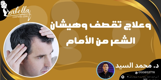 علاج تقصف الشعر
